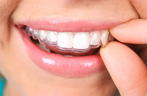 invisalign teeth gap