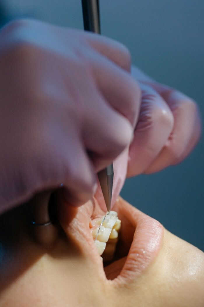 Best clear braces Best clear braces