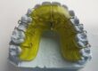 Clear retainers for teeth