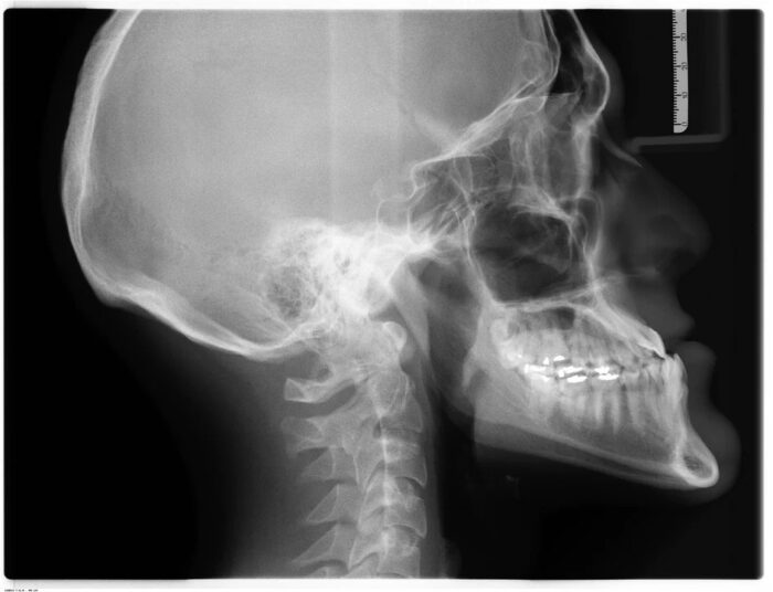 How to fix underbite without surgery How to fix underbite without surgery