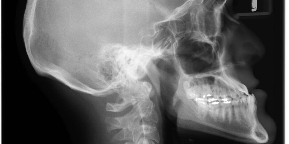 How to fix underbite without surgery How to fix underbite without surgery