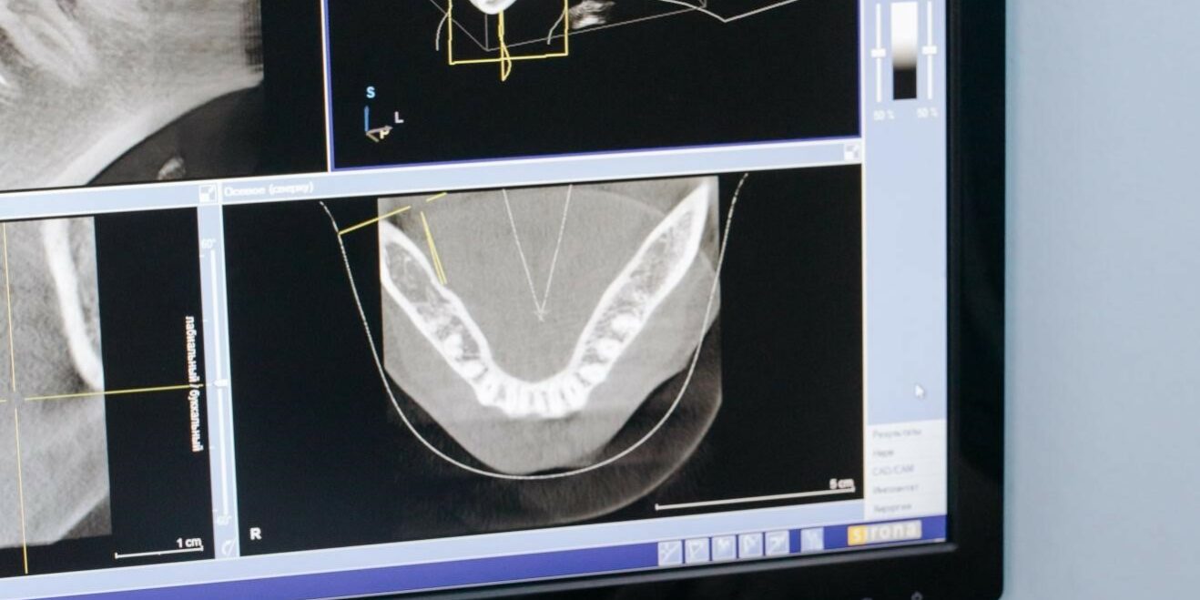 Underbite correction without surgery Underbite correction without surgery