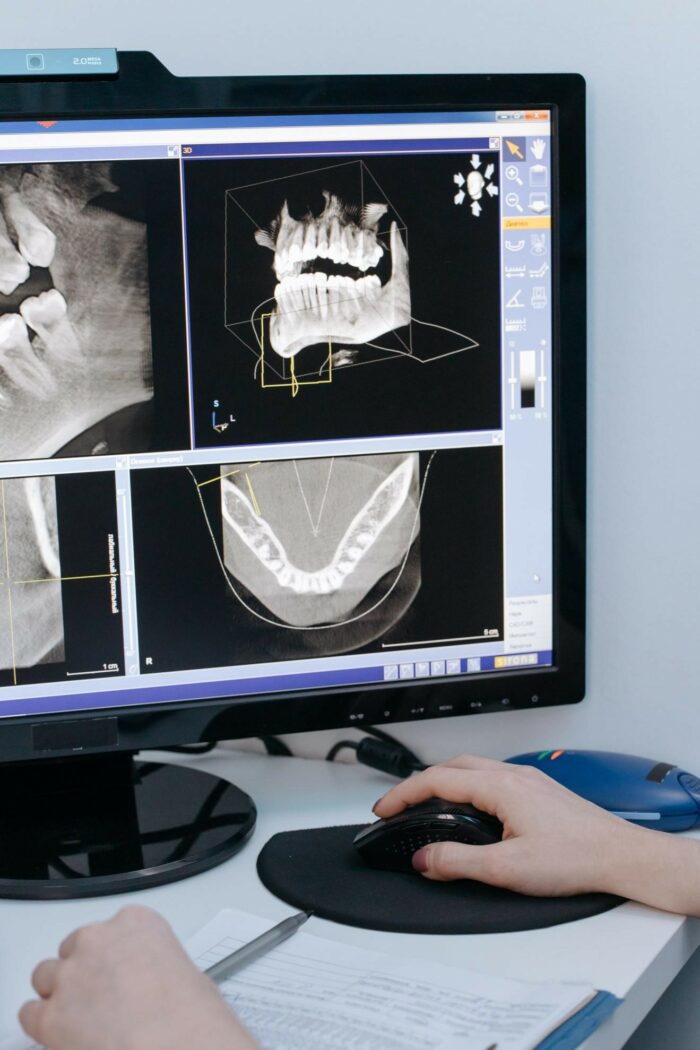 Underbite correction without surgery Underbite correction without surgery