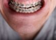 Overbite before and after