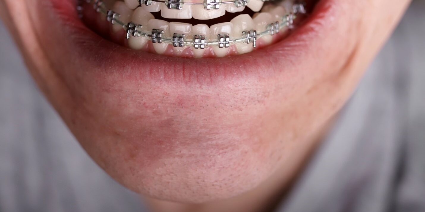 Overbite before and after Overbite before and after