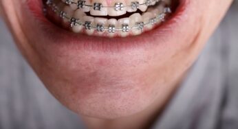 Overbite Correction and Benefits – Overbite Before and After