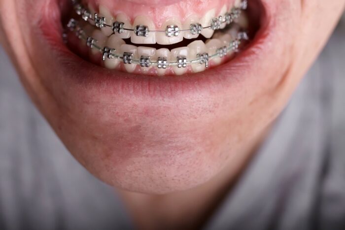 Overbite before and after Overbite before and after