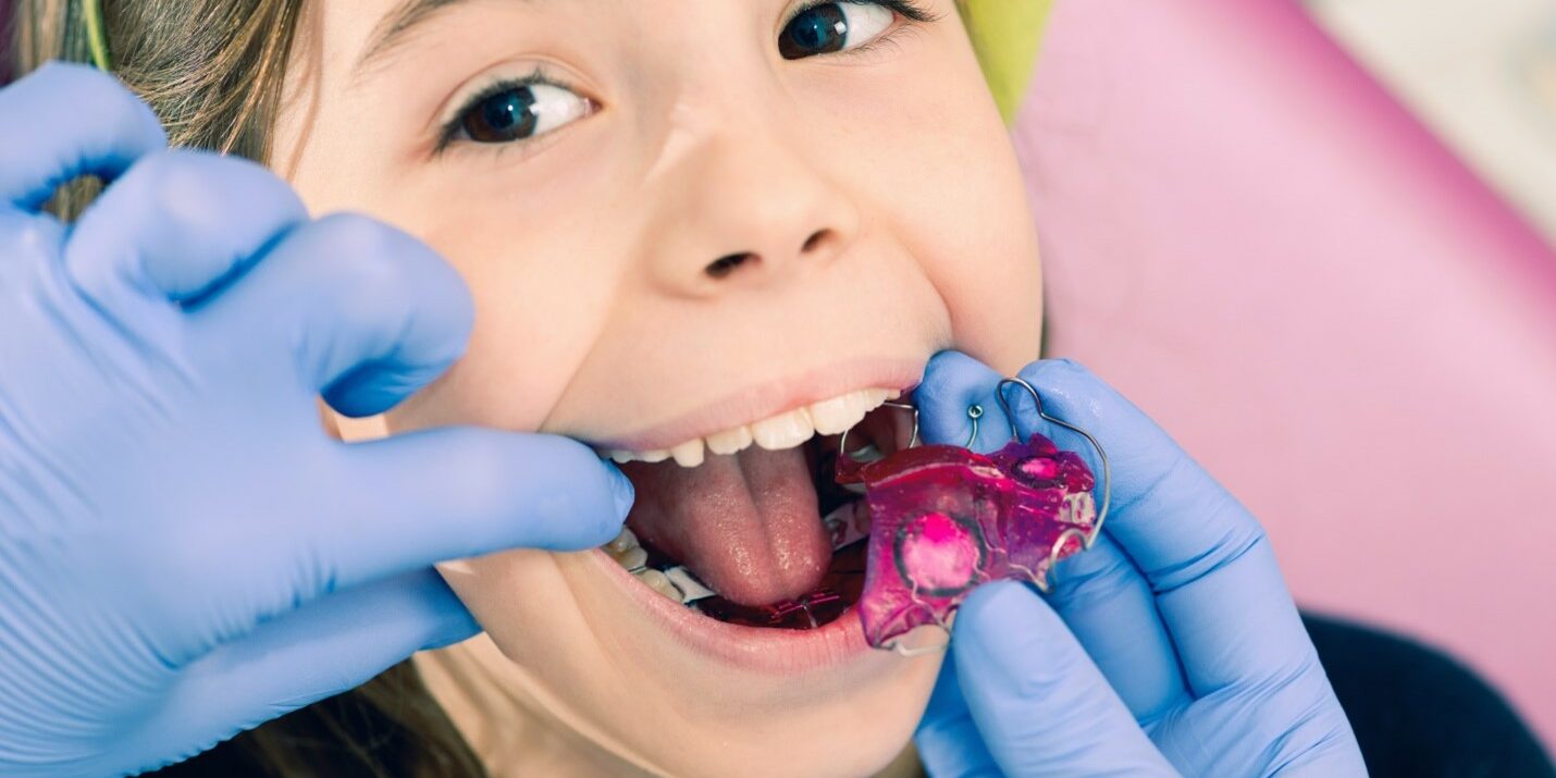 Palate expander Palate expander