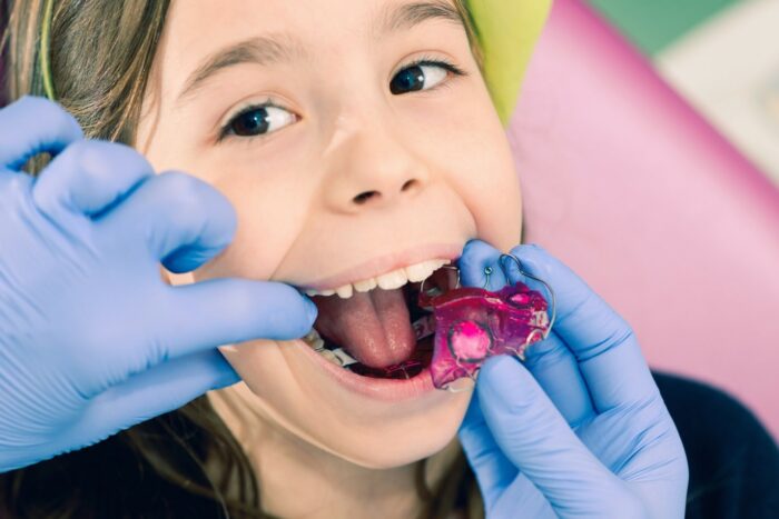 Palate expander Palate expander