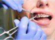 Self-Ligating Braces