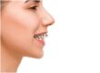 Overjet in Teeth