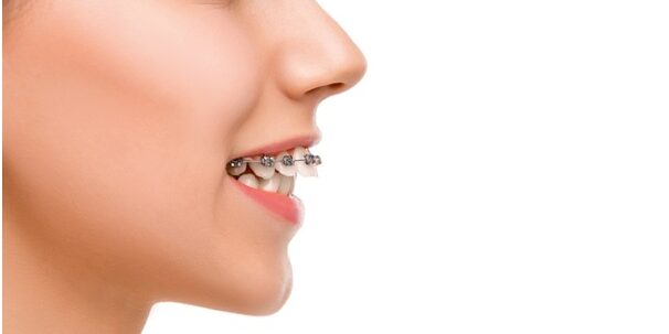 Overjet in Teeth Overjet in Teeth