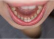 Permanent Retainers