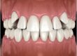 Impacted Canine Tooth