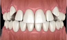 Impacted Canine Tooth
